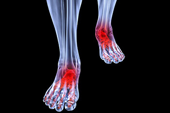 arthritic foot and ankle care treatment in Port St. Lucie, FL 34952