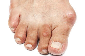 bunions treatment in Port St. Lucie, FL 34952