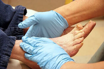 diabetic foot treatment in Port St. Lucie, FL 34952