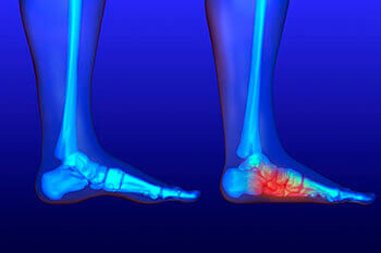 Flat feet and Fallen Arches treatment in Port St. Lucie, FL