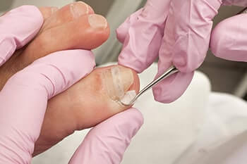 Ingrown toenails treatment in Port St. Lucie, FL 34952
