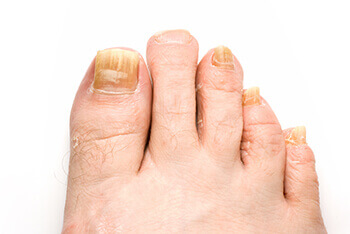 fungus toenails treatment in Port St. Lucie, FL 34952