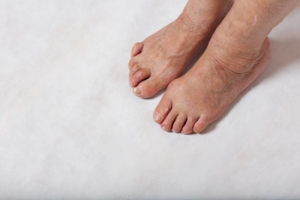 Hammertoes and Women’s Shoe Choices