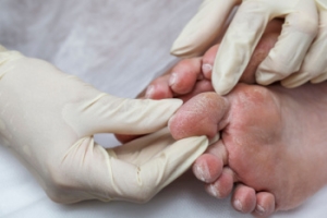 Foot Care Tips for Diabetic Paients