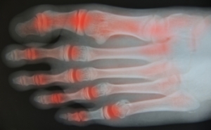 Ankle Osteoarthritis and How to Manage It