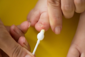 When a Baby Has an Ingrown Toenail