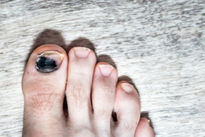 Causes of Black Toenails in Runners