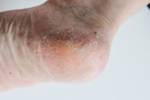 How a Podiatrist Can Help Cracked Heels