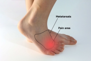 Symptoms of Morton&rsquo;s Neuroma
