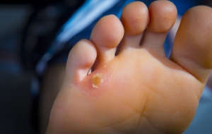 Excessive Friction May Lead to Corns