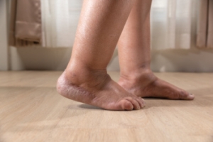 When Feet and Ankles Begin to Swell