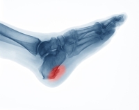 What Are Heel Spurs?